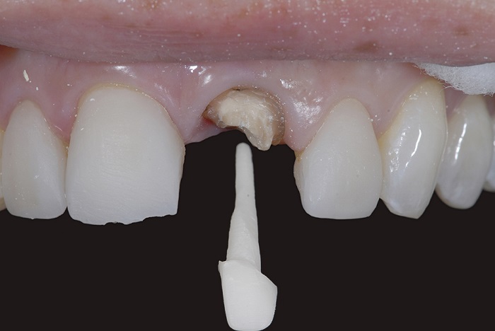 Dispozitiv corono-radicular