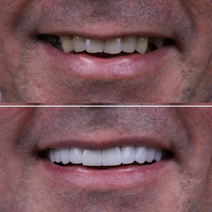 Înaine și după tratamentul cu fațete dentare