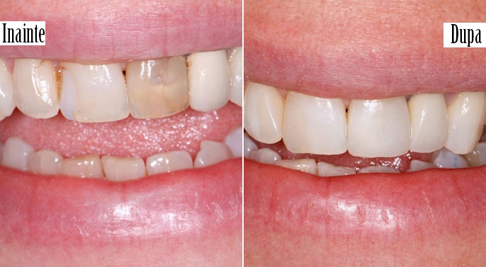 Albire dentară dinți devitali