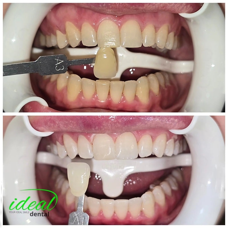 Înainte și după albirea dentară la Ideal Dental