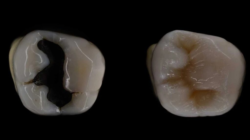 Înainte și după aplicarea plombei dentare
