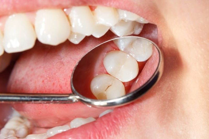 Plombă dentară din compozit cu aspect natural
