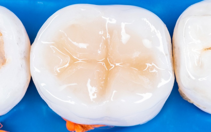 Plombă dentară molar