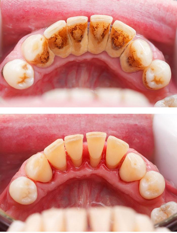Înainte și după igienizarea dentară