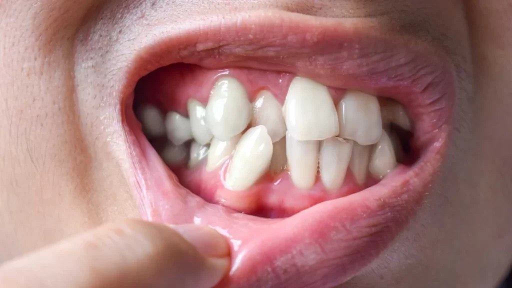 Anomalie dentară (dinți strâmbi și maxilar nealiniat)