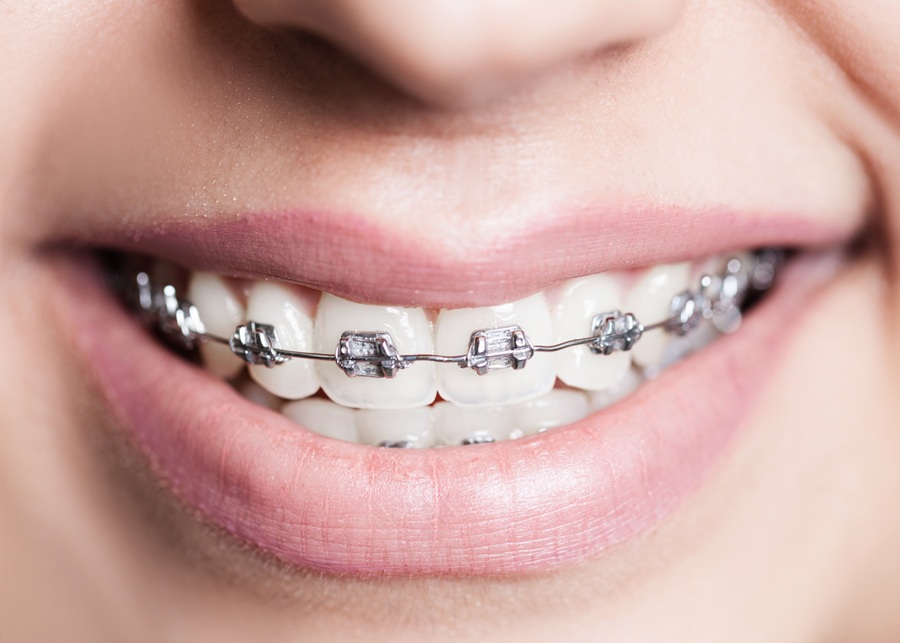 Aparat dentar fix