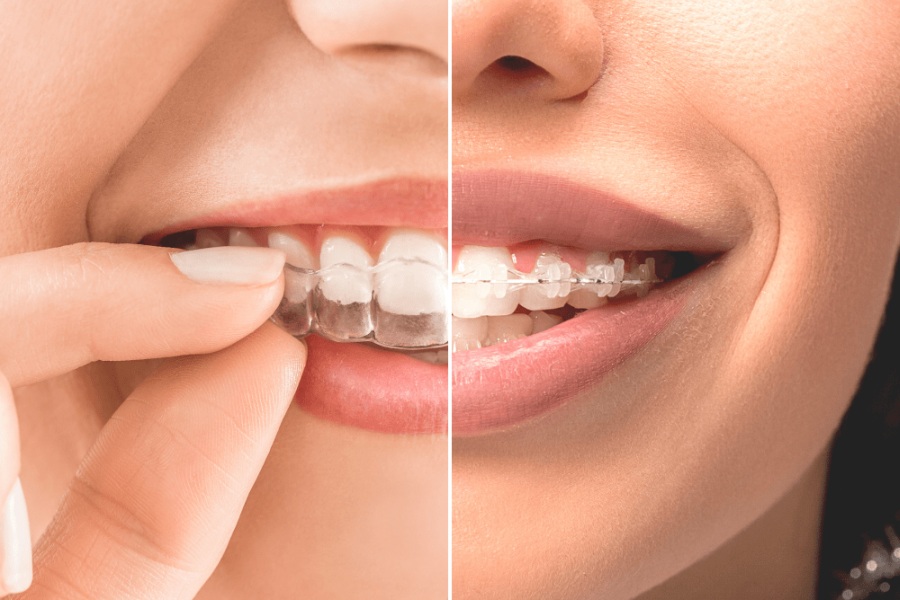 Aparat dentar invizibil