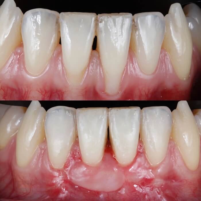 Corecție gingivală - înainte și după