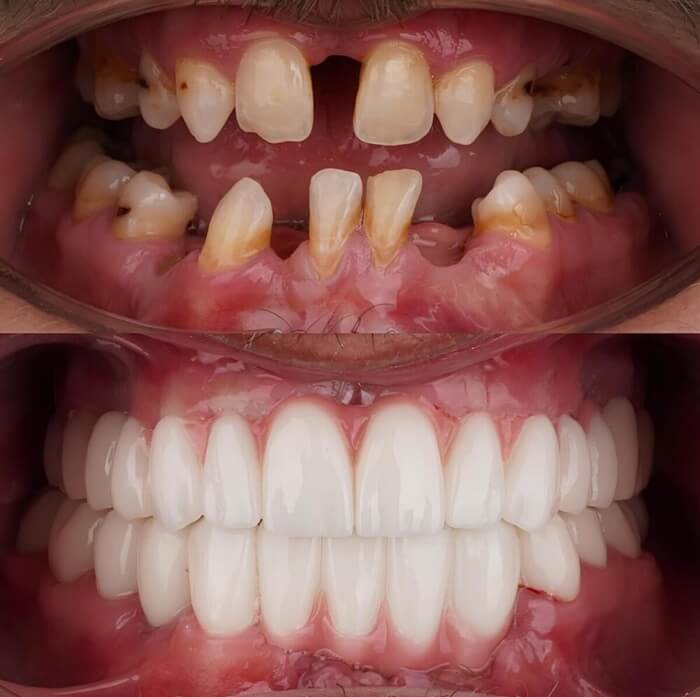 Coroane dentare estetice