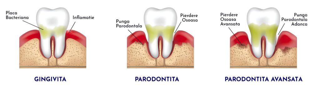Tipuri de boli parodontale