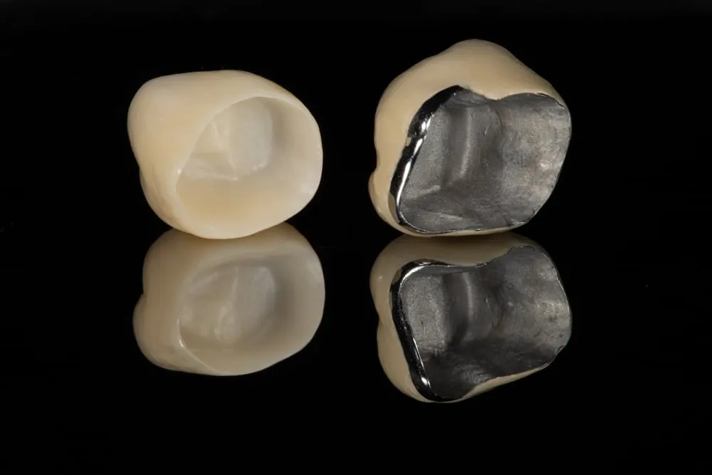 Coroană dentară din porțelan vs. coroană metalo-ceramică (semiporțelan)