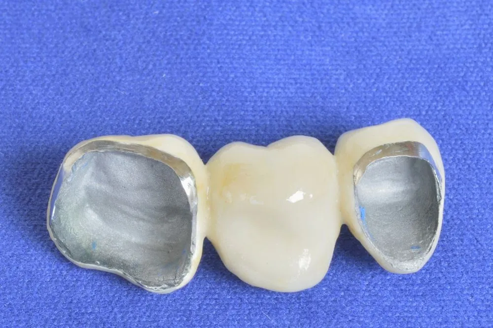 Coroane dentare metalo-ceramice