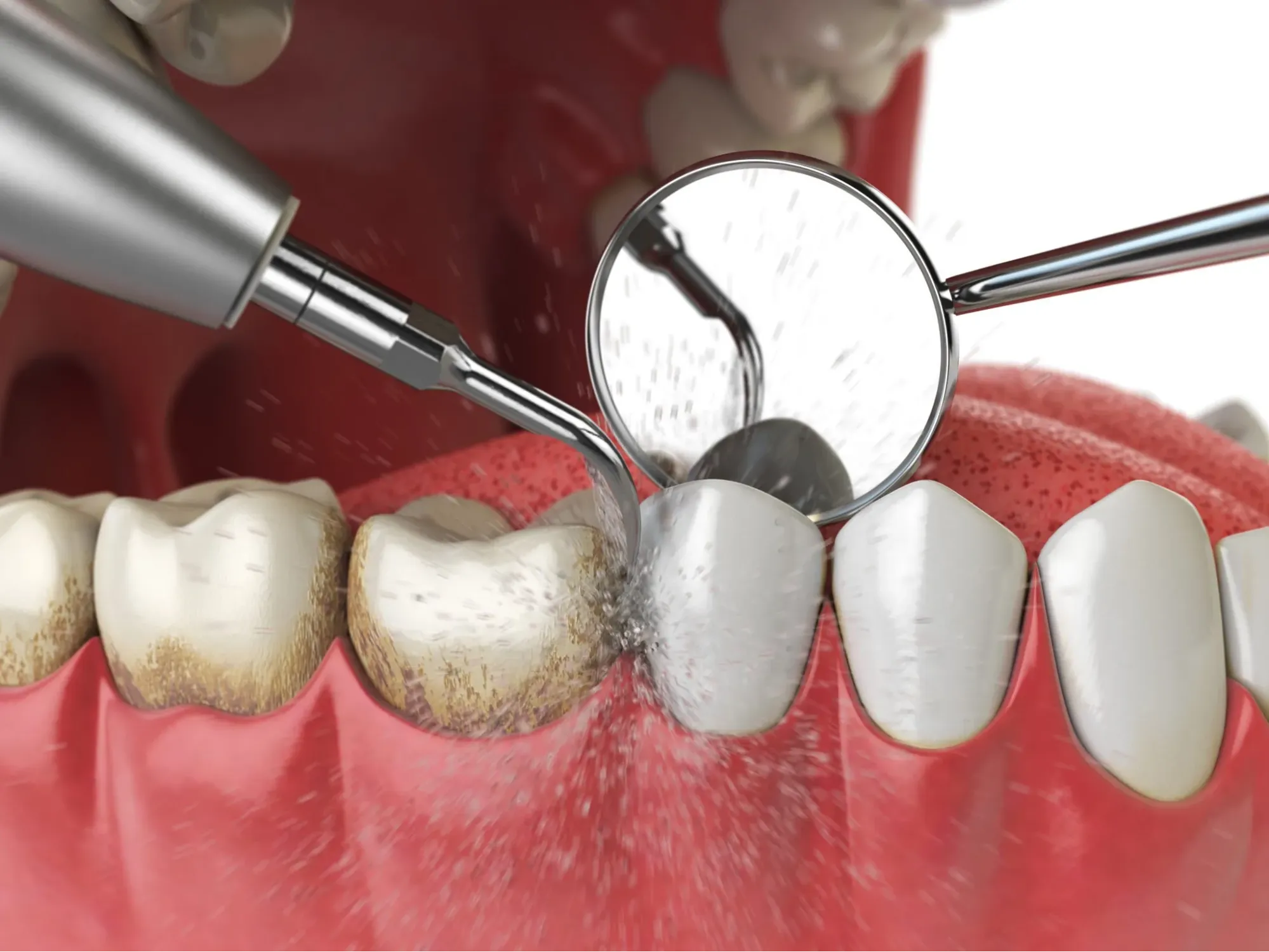 Instrument ultrasonic folosit pentru curățarea tartrului subgingival