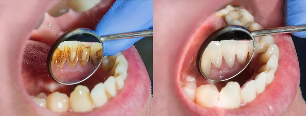 Comparație înainte și după detartraj dentar, cu depuneri de tartru îndepărtate de pe dinții inferiori