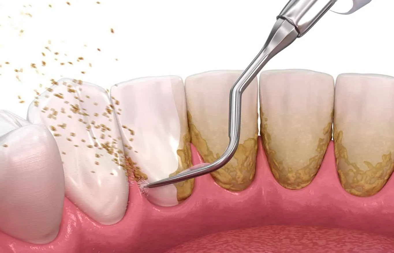 Instrument dentar care îndepărtează tartrul de sub gingie